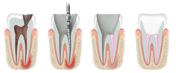 Root Canal Treatment (Endodontics)